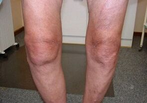 Cómo tratar la artrosis de la articulación de la rodilla