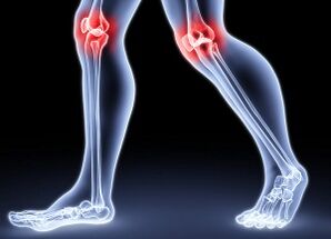 Las razones para el desarrollo de la artrosis de la rodilla