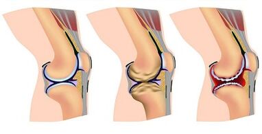Etapas de desarrollo de la artrosis de la articulación de la rodilla