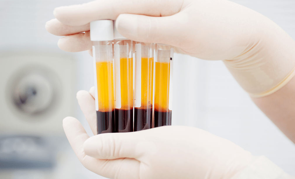 Plasma rico en plaquetas para la terapia con PRP en artrosis